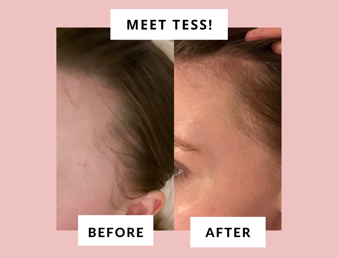How Tess Reversed Her Receding Hairline!
