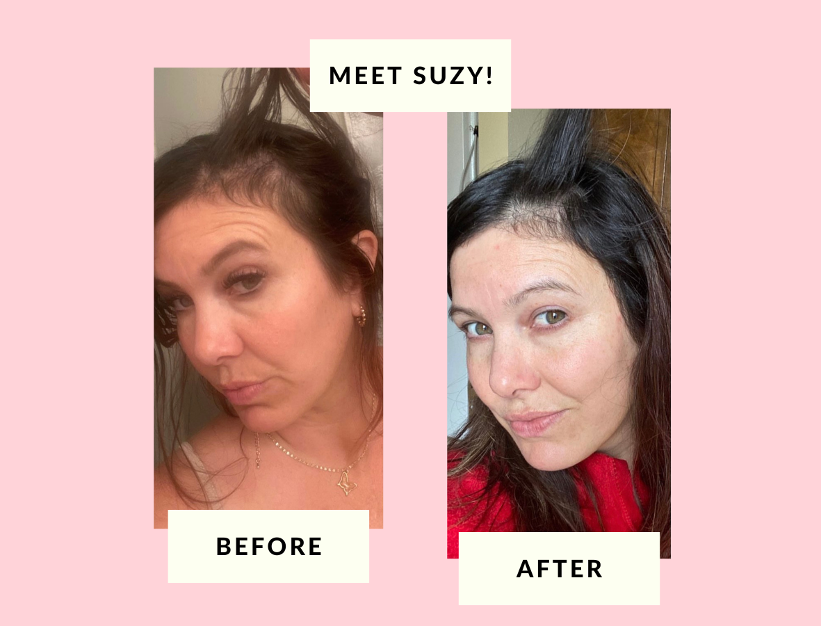 How Suzy Overcame Her Postpartum Hair Loss!